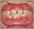 先天性欠如歯【永久歯の先天性欠如】の症例15