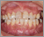 上顎前突症【出っ歯・永久歯列期】の症例33