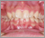 先天性欠如歯【永久歯の先天性欠如】の症例16