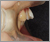 上顎前突症【出っ歯・永久歯列期】の症例34