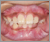 埋伏歯【混合歯列期】の症例8