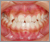 臼歯部交叉咬合【顔面非対称・永久歯列期】の症例8