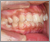 先天性欠如歯【永久歯の先天性欠如】の症例17