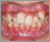先天性欠如歯【永久歯の先天性欠如】の症例18