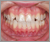 矮小歯の症例4