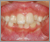 先天性欠如歯【永久歯の先天性欠如】の症例19