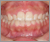 上顎前突症【出っ歯・永久歯列期】の症例37