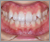 先天性欠如歯【永久歯の先天性欠如】の症例20