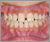 埋伏歯【永久歯列期】の症例7