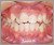 上顎前突症【出っ歯・永久歯列期】の症例38