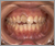 外傷歯の症例2